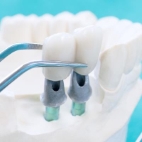 All on 6 and All on 4 Dental Implants in Turkey