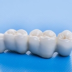 Dental Bridge Work in Turkey