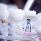 Dental Implants in Turkey