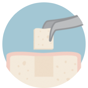 smile makeover in Turkey