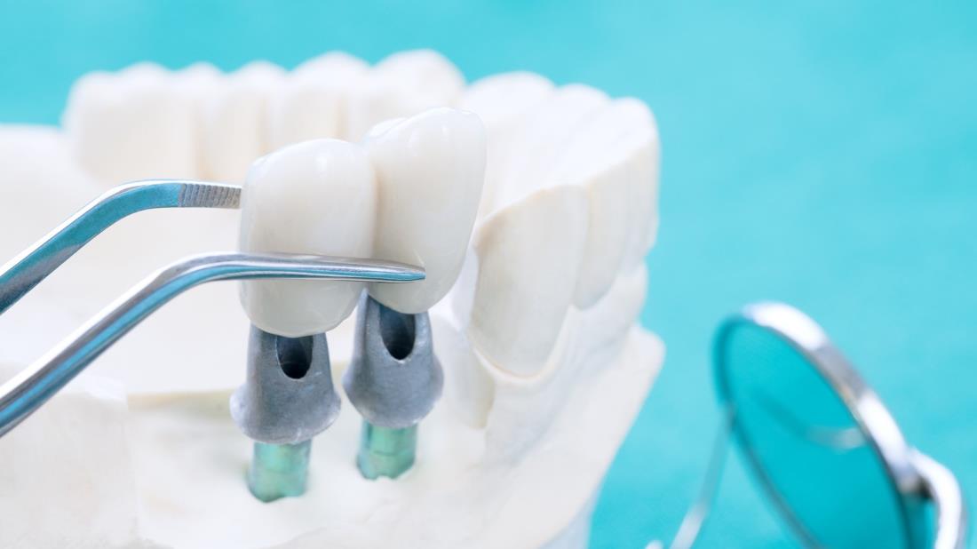 All on 6 and All on 4 Dental Implants in Turkey