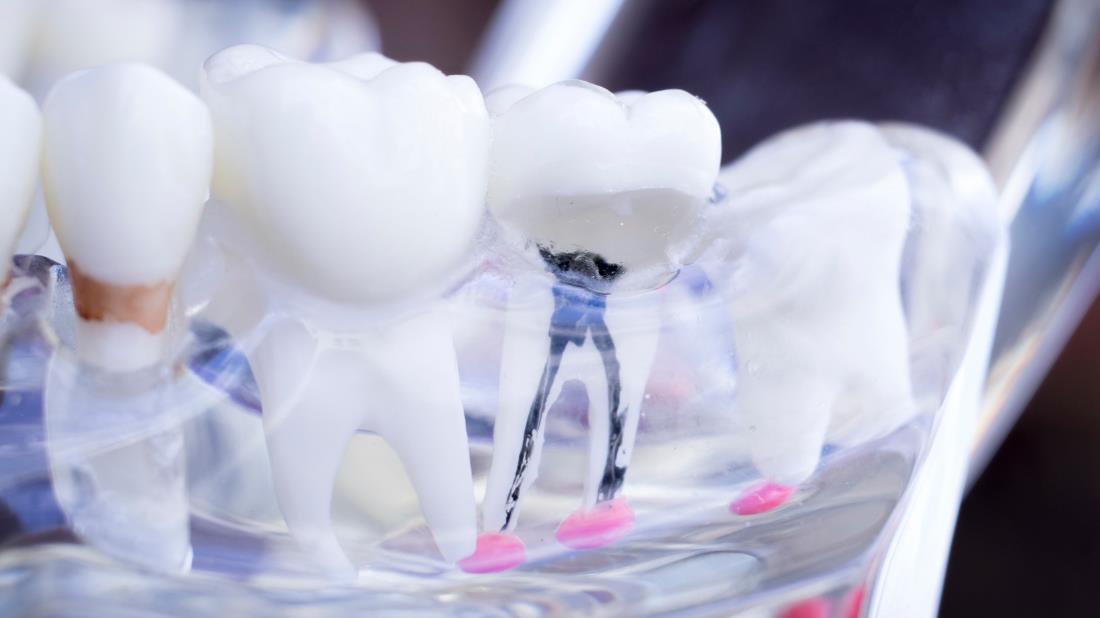 Dental Implants in Turkey