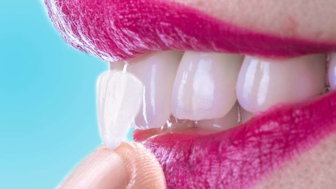 Dental Veneers in Turkey